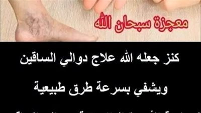 كنز جعله الله علاج دوالي الساقين ويشفي بسرعة