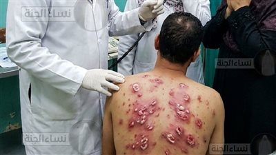 وجدتُ ثلاثين بقعة حمراء على ظهر زوجي تشبه بيض الحشرات