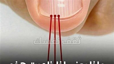 ماذا تعني الخطوط على الأظافر وأسباب ظهورها؟
