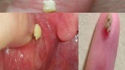 خطير جدا إذا كان يخرج من فمك هذا الشيء مع رائحة كريهة فلا تهمل الموضوع