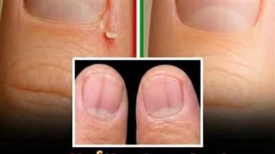 علامات الأظافر: تكشف مشاكل صحية لا ينبغي تجاهلها!